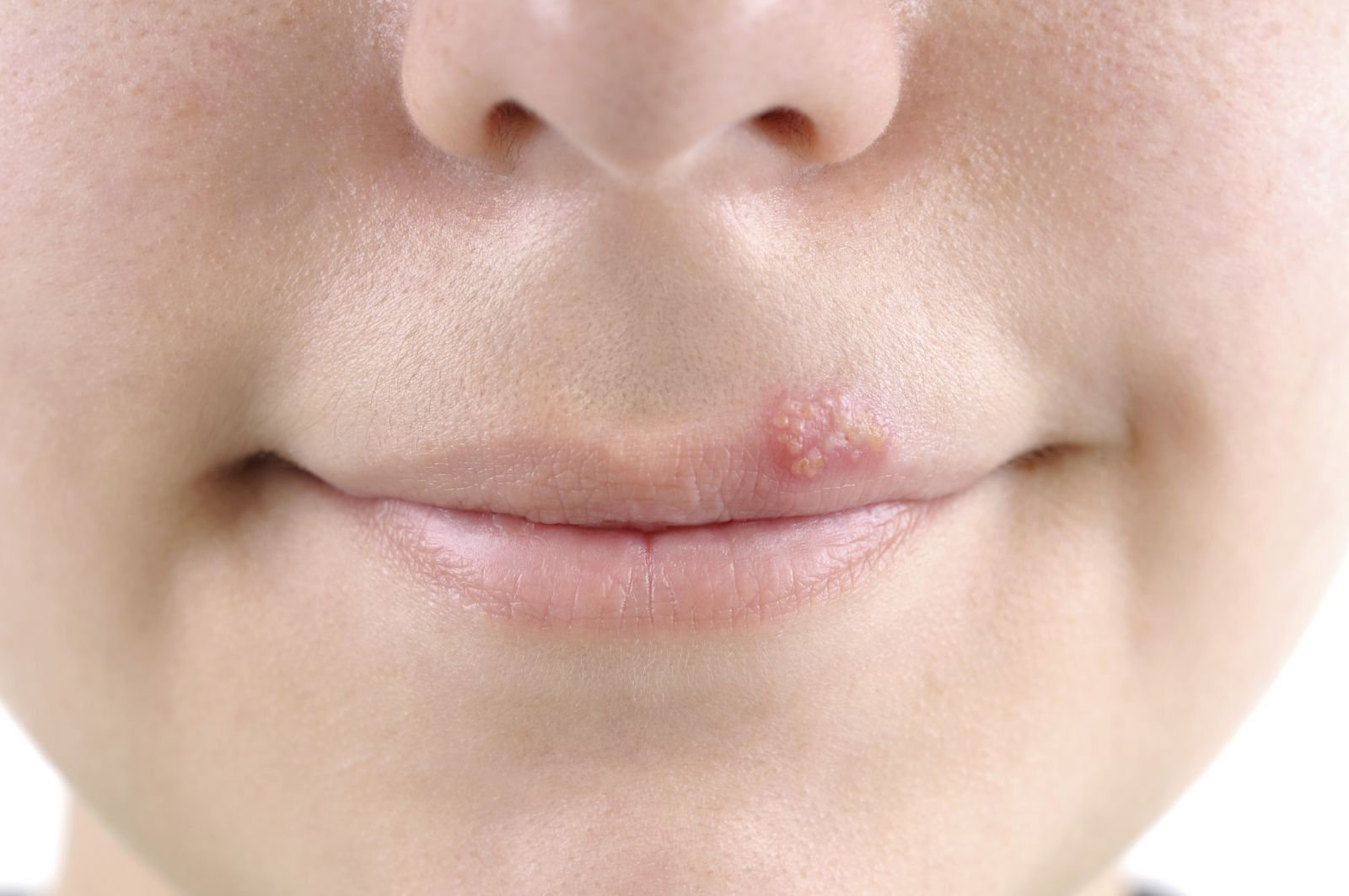 What is the best way to treat cold sores? This is what physicians advise